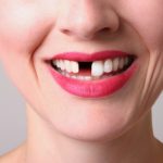 missing teeth treatment in jaipur