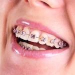 dental braces in jaipur