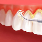 periodontal treatment in jaipur