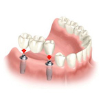 prosthodontic treatment in jaipur