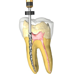 root canal treatment in jaipur