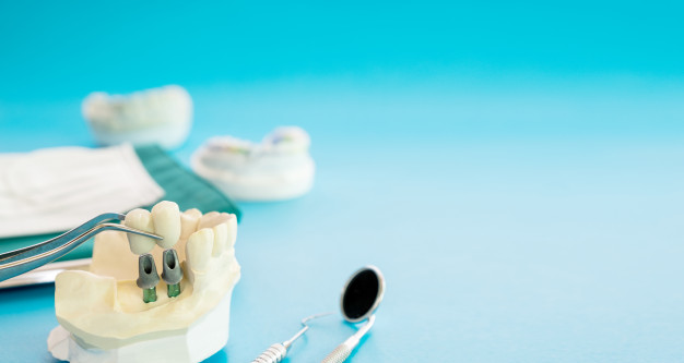 Dental Implants A Permanent Solution to Tooth Loss